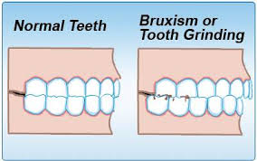 How do i stop clenching my teeth. Dental Health And Teeth Grinding Bruxism La Jolla Cosmetic Dentistry Orthodontics