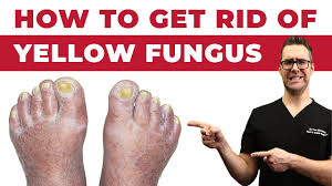 Image result for Pitting nails feet