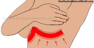 Image result for heat rash under breasts