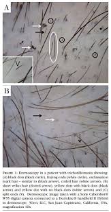 Black dots correlate with disease activity in alopecia areata and are a negative prognostic factor. Scielo Brasil Pistas Dermatoscopicas Para Diferenciar A Tricotilomania Da Alopecia Areata Em Placa Pistas Dermatoscopicas Para Diferenciar A Tricotilomania Da Alopecia Areata Em Placa