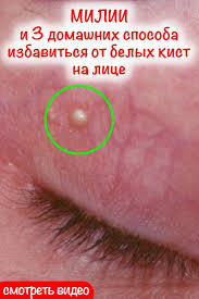 как избавиться от белых пятен на лице в домашних условиях Dannaya Kista V Diametre Sostavlyaet Priblizitelno Primerno 2 Mm I Lokaliziruetsya V Oblasti Nosa Shek I Glaz Hotya Mozhet Poyavlyat Lico Fakty O Zdorove Zdorove