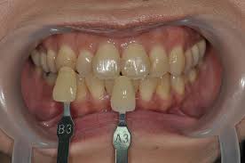 cases of in office bleaching prestige dental care