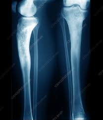 Image result for Osteomyelitis XRay
