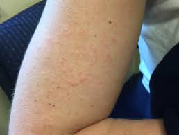 Streptokokken sind eine bakterienart, die oft harmlos sind, jedoch manchmal erkrankungen auslösen können. Infektiose Mononukleose Dermatly Com Ihre Hautseite