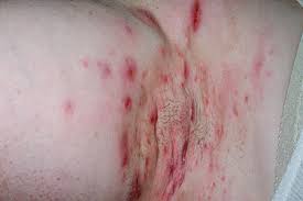 Hidradenitis Suppurativa Nedir Tresim