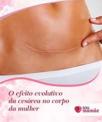 O Efeito Evolutivo Da Cesarea No Corpo Da Mulher As Mulheres Com Uma Pelvis Estreita Nao Teriam Massagem Na Barriga Exercicio Para Gravidas Dicas De Gravidez