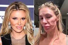 Brandi Glanville 'Sick of the Way I Look' amid Facial Parasite Crisis