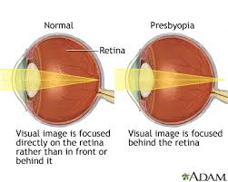 Image result for Presbyopia