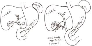 Patients should no longer need pain how long after hernia surgery can i have sex? Laparoscopic Cholecystectomy Removal Of The Gall Bladder Using Keyhole Surgery Hull University Teaching Hospitals Nhs Trust