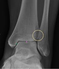 Image result for Ankle XRay