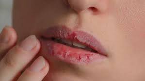 Image result for Lip Cancer