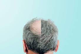 دليلك الكامل عن عمليات زراعة الشعر 2021 وأحدث التقنيات المستخدمة أخبار صحيفة الرؤية