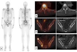 Old age at prostate cancer diagnosis has been associated with poor prognosis in several studies. Frontiers Imaging For Metastasis In Prostate Cancer A Review Of The Literature Oncology