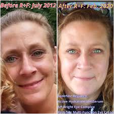 🙌 Results take time and consistency but what a difference!! 😍 Who's ready  to have the best skin of their life?!?