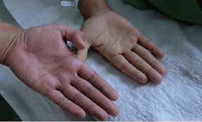 Symptoms of escherichia coli become an expanded clinical picture of intestinal dysbiosis: 7 Symptoms Of Leukemia In Children Medanta