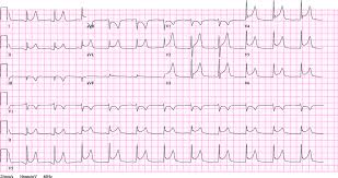 Pericarditis vs benign early repolarisation. Ecg Pericarditis Ecg Abnormalities Suggestive Of Pericarditis In A 40 Download Scientific Diagram