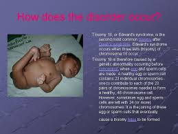 Parental origin of the extra chromosome 18 in edwards syndrome. Trisomy 18 Or Edwards Syndrome By Austin Scharfstein