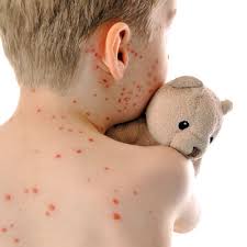 Hohes fieber, geschwollene lymphknoten und halsschmerzen sind typisch für das pfeiffersche drüsenfieber, auch kusskrankheit genannt. Plotzlicher Ausschlag Bei Kindern Welche Krankheit Steckt Dahinter Elternwissen Com