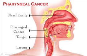 Throat cancer symptoms include a painless lump in the neck, a persistent sore throat, ear pain, and difficulty swallowing with associated weight loss in more advanced cases. Throat Cancer Pharyngeal Cancer Types Causes Symptoms Diagnosis And Treatment