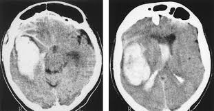The middle meningeal artery arises at the intracranial fossa—a cavity on the side of the cranium—where it branches off from the maxillary artery which is connected to the external carotid. Traumatic False Aneurysm Of The Middle Meningeal Artery Causing An Intracerebral Hemorrhage Case Report And Literature Review Sciencedirect