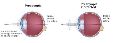 Image result for Presbyopia