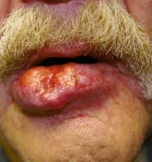 Image result for Lip Cancer