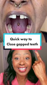 How to Close Tooth Gaps with Porcelain Veneers