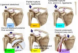 Maybe you would like to learn more about one of these? Separated Shoulder Causes Symptoms Exercises Treatment
