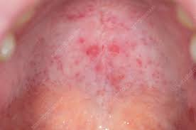 Image result for Hand foot and mouth disease HFMD roof of mouth