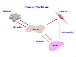 Image result for Cachexia in Cancer