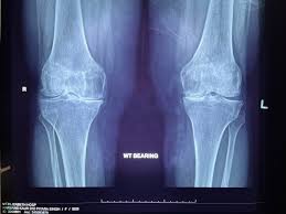 Image result for Knee XRay
