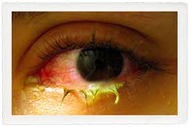 Image result for Bacterial Conjunctivitis