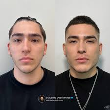 Masculinización facial By: Dr. Daniel Diaz Torrado