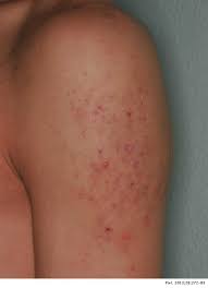 Este hongo es uno de los posibles responsables de la afección micótica de la piel humana (tiña), sobre todo cuando ésta se encuentra, como en el moho negro (stachybotrys chartarum). Dermatosis En El Deporte Piel Formacion Continuada En Dermatologia
