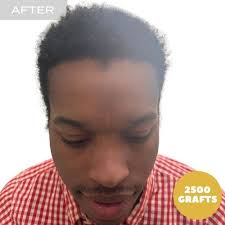 Dr. Adam Rubinstein: Miami's Premier Hair Transplant Expert