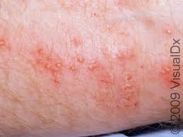 Image result for Deep Folliculitis