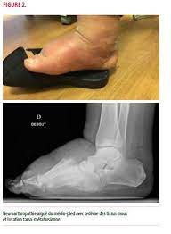 Ces informations aident les médecins à identifier les. Le Pied De Charcot Diabetique Regards Croises Sur La Litterature Et Sur 5 Ans De Pratique Aux Cliniques Universitaires Saint Luc Louvain Medical