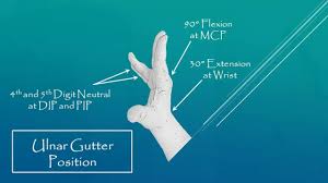 Image result for Ulnar Gutter Cast