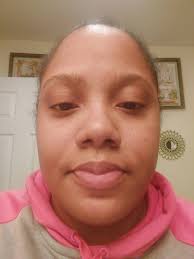 What causes random jawline breakouts?