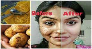 Patates Maskesi Nasil Yapilir Faydalari Nelerdir Kullananlar Memnun Mu Cilt Bakimim Cilt Bakimim Skin Spots Dark Spots On Skin Remove Dark Spots