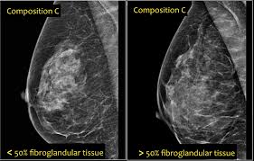 The Radiology Assistant Bi Rads For Mammography And