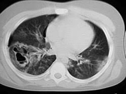 Image result for Pulmonary Contusion