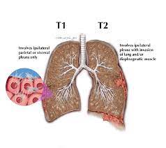 See full list on mayoclinic.org Mesothelioma Treatment Singapore International Centre For Thoracic Surgery
