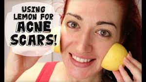 Fade Acne Scars With Lemon Naturally Lighten Skin At Home Updated Youtube