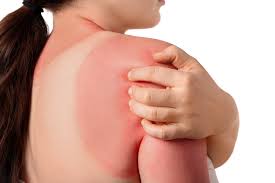 Image result for Sunburn