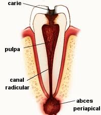 Mentionez ca nu pot extrage dintele pt ca. Abces Dentar Cauze Simptome Si Posibilitati De Tratament