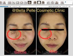 Birthmark Removal In Sydney