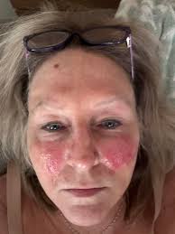 Weird symptoms just show up for me today little blister like things