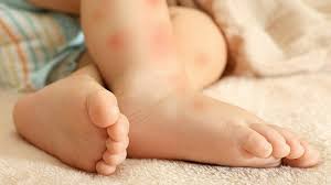Adrenal cortex hormones naturally prevent rashes and itching. 7 Natural Remedies For Skin Rash Blog Puriya Com