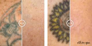 The … laser tattoo removal read more » Old Vs New Tattoo Removal Which Is Easier To Remove
